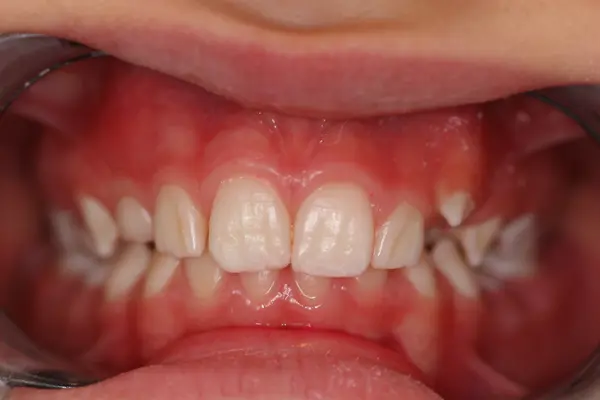 Amélogénèse imparfaite antérieure Dentisterie Pédiatrique Bordeaux, gestion douleur chez l’enfant dentiste