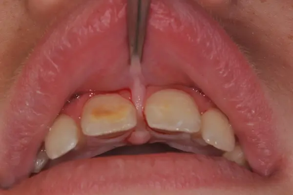 Chirurgie dentaire frein clampé Dentisterie Pédiatrique Bordeaux, dentiste pédiatrique