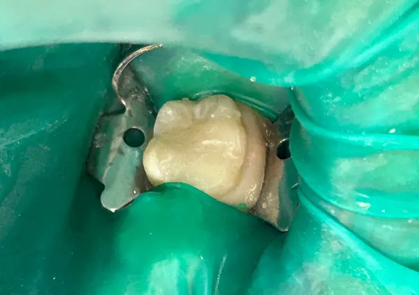 Image composite sous digue Dentisterie Pédiatrique Bordeaux, dentiste pédiatrique