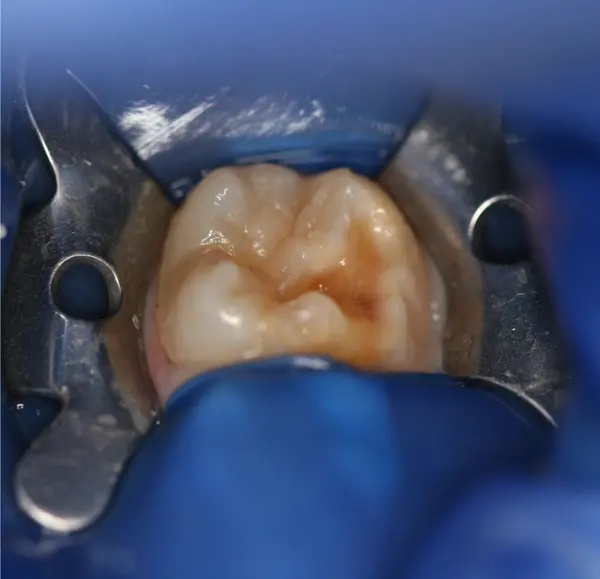 Image composite sous digue Dentisterie Pédiatrique Bordeaux, traumatologie
