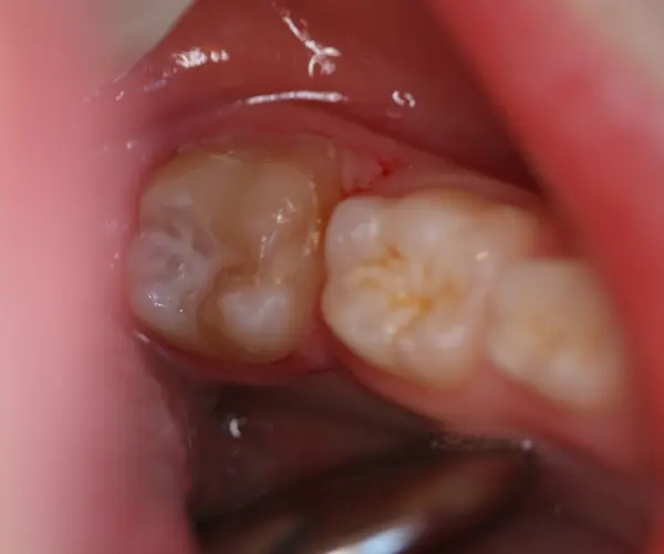 Image traitement des caries Dentisterie Pédiatrique Bordeaux, gestion douleur chez l’enfant dentiste