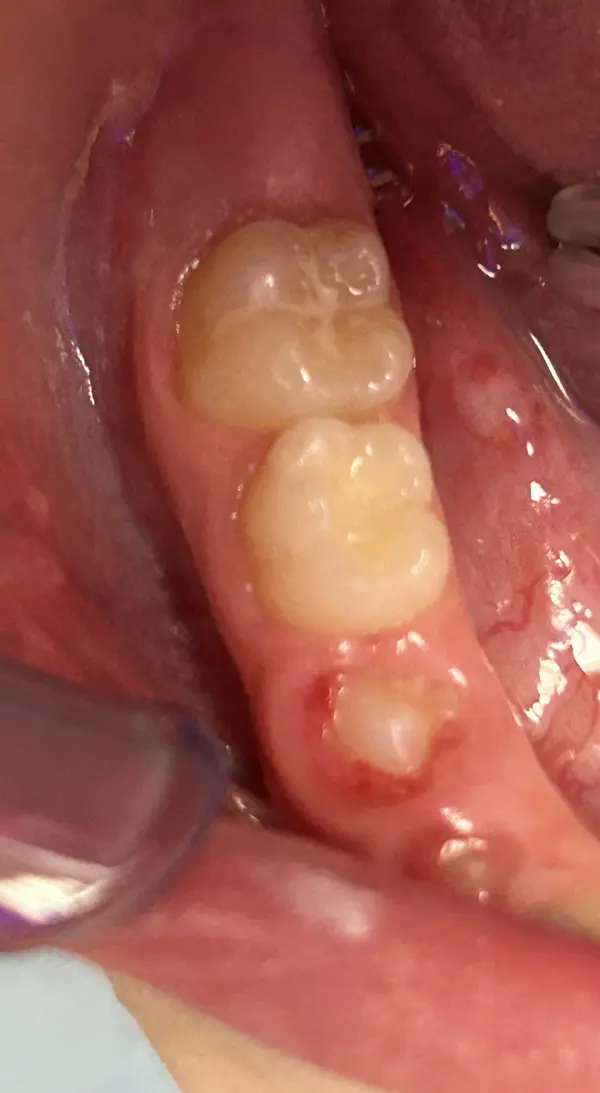 Comblement de sillons Sealant Dentisterie Pédiatrique Bordeaux, suivi dentaire enfant