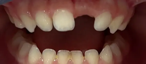 Avant prothèse pédiatrique Dentisterie Pédiatrique Bordeaux, anomalie email
