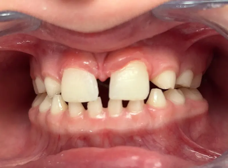 Image après traitements esthétiques Dentisterie Pédiatrique Bordeaux, soin dentaire