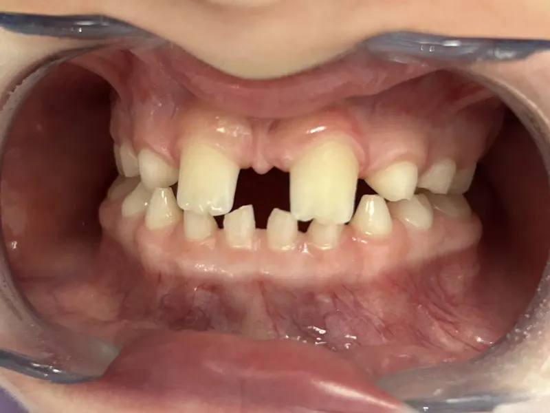 Image avant traitements esthétiques Dentisterie Pédiatrique Bordeaux, suivi dentaire enfant
