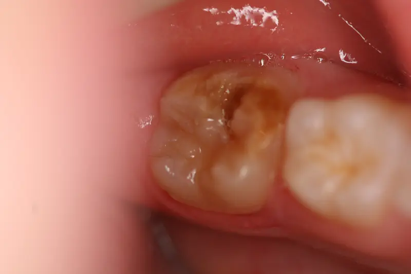 MIH anomalies, taches ou couleurs sur les dents par Dentisterie Pédiatrique Bordeaux, traumatologie