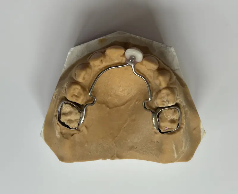 Image prothèse pédiatrique Dentisterie Pédiatrique Bordeaux, anomalie email