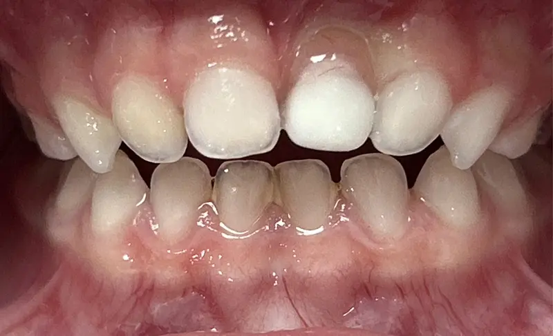 Après prothèse pédiatrique Dentisterie Pédiatrique Bordeaux, anomalie email